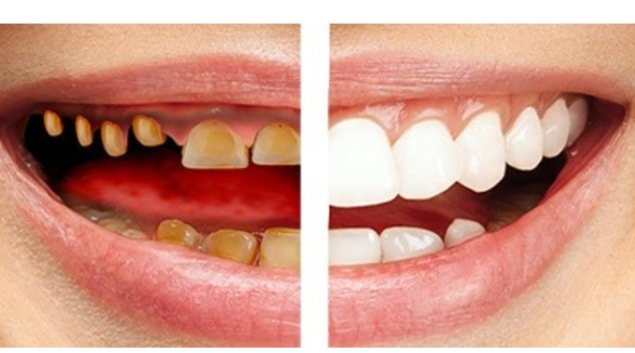 Fixing Jaw Fractures