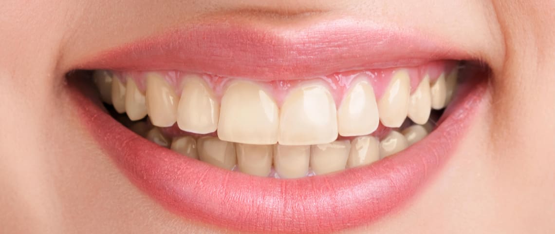 teeth whitening in bangalore