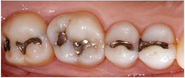 Tooth Colored Fillings in vijayanagar