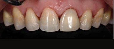 Tooth Colored Fillings in bangalore