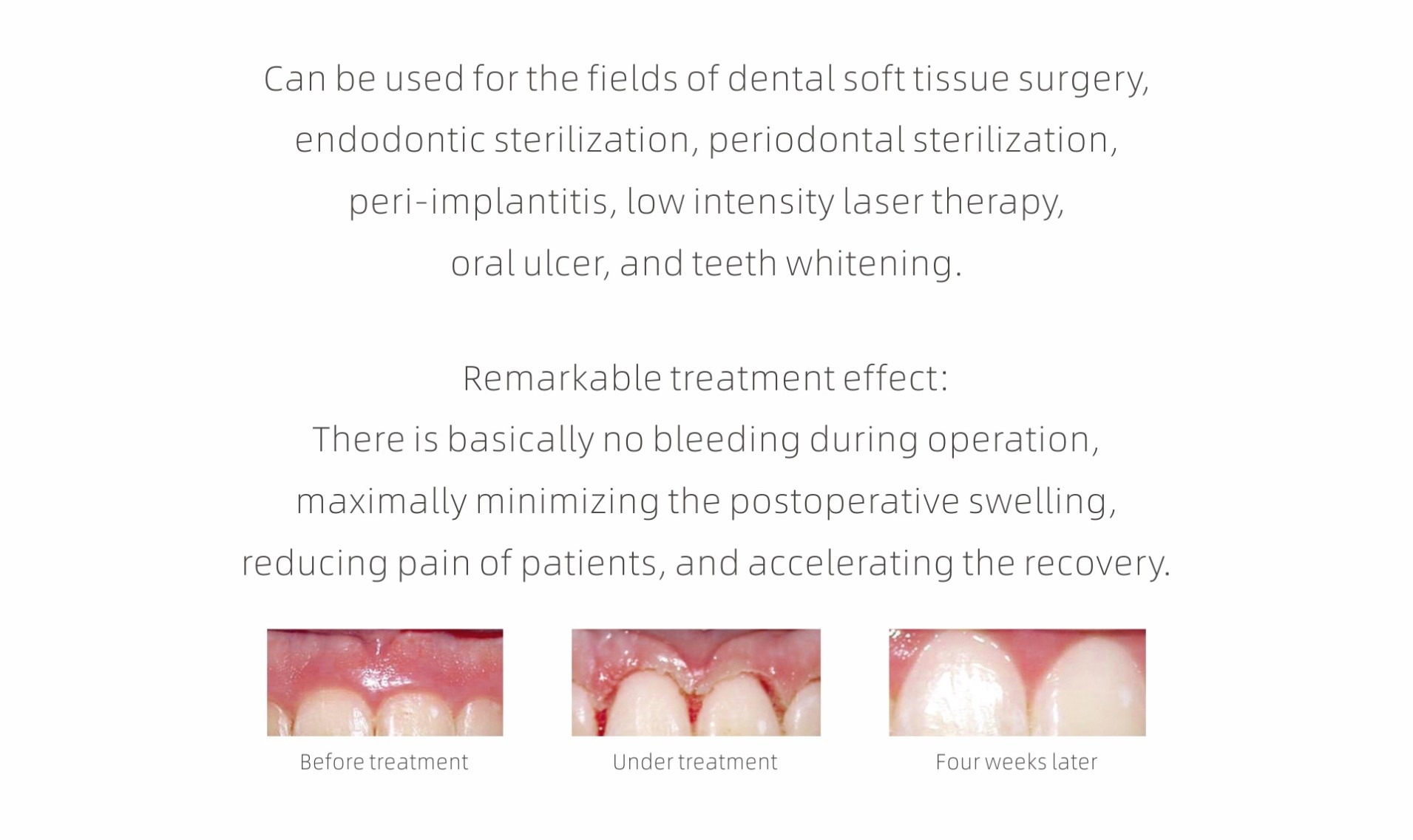 Laser Dentistry in Bangalore