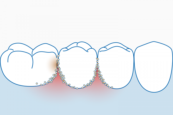 prone teeth