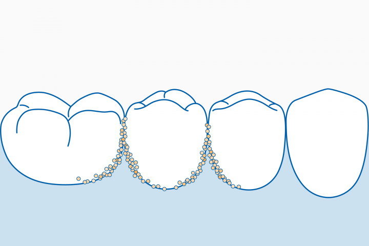space in teeth