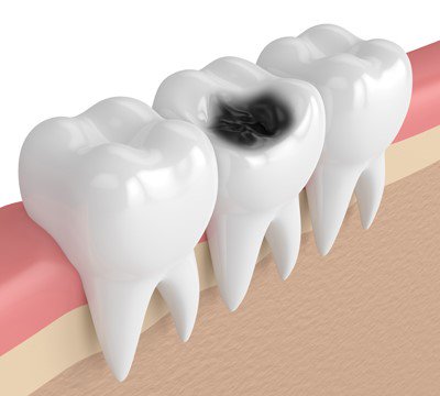 tooth decay