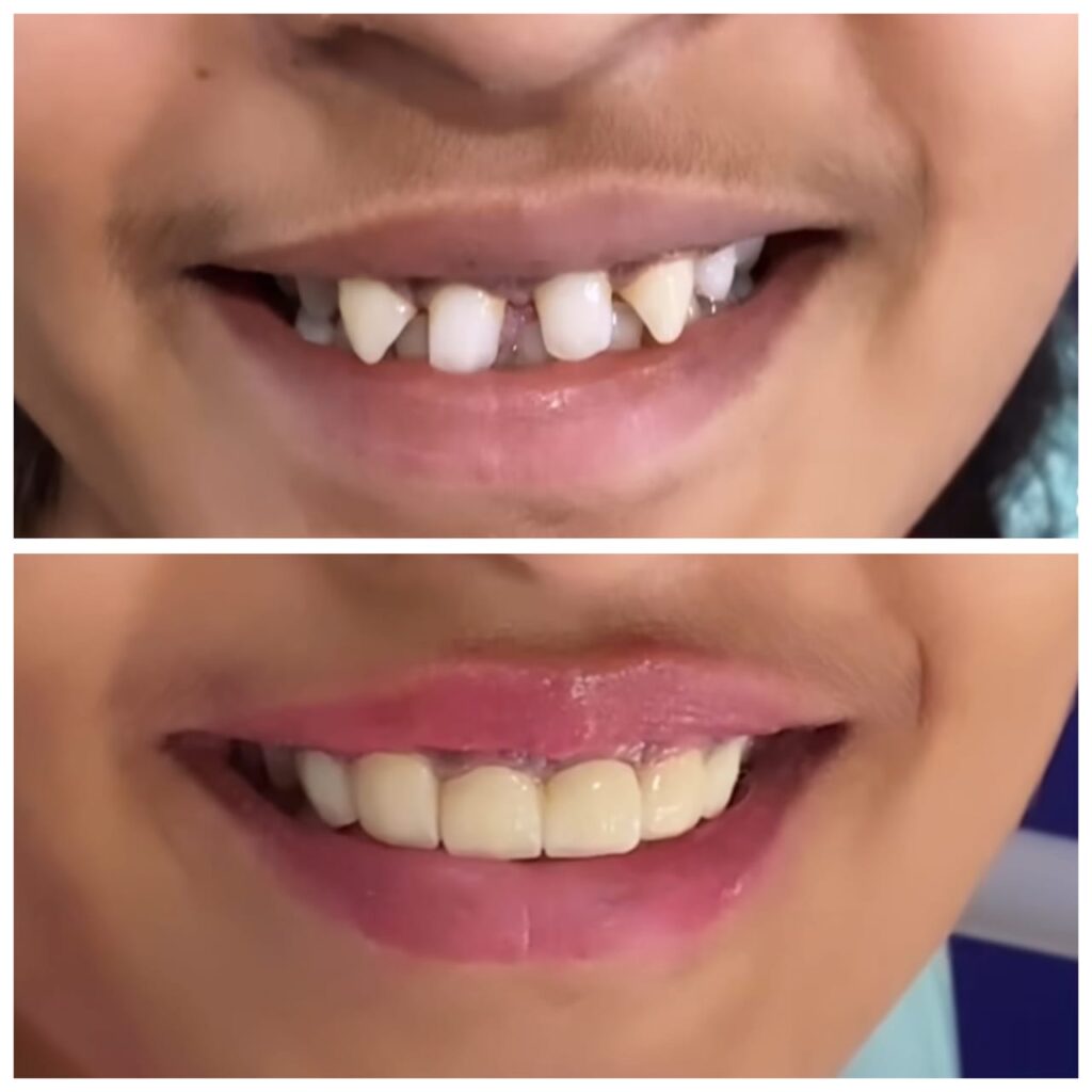 dental crown in bangalore