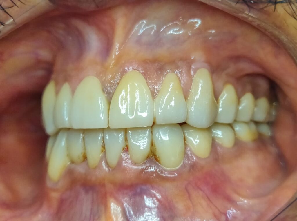 Full Mouth Rehabilitation with Dental Crowns