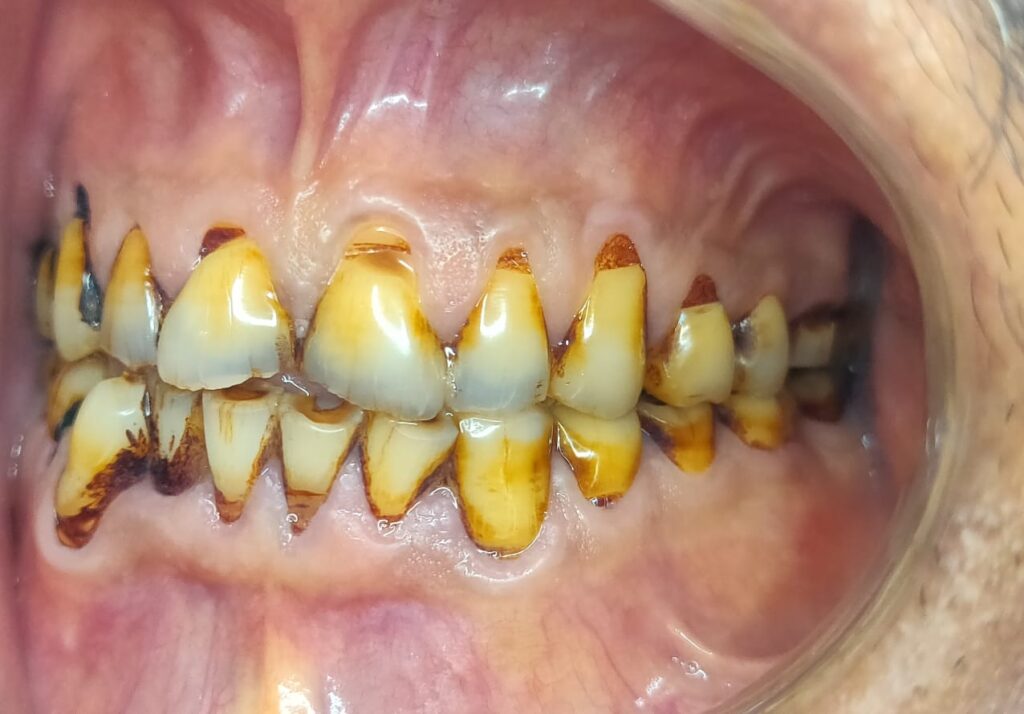 Full Mouth Rehabilitation with Dental Crowns
