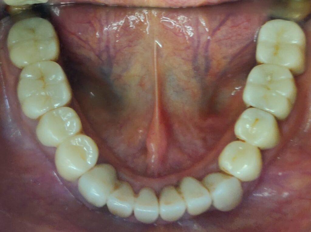 Full Mouth Rehabilitation with Dental Crowns