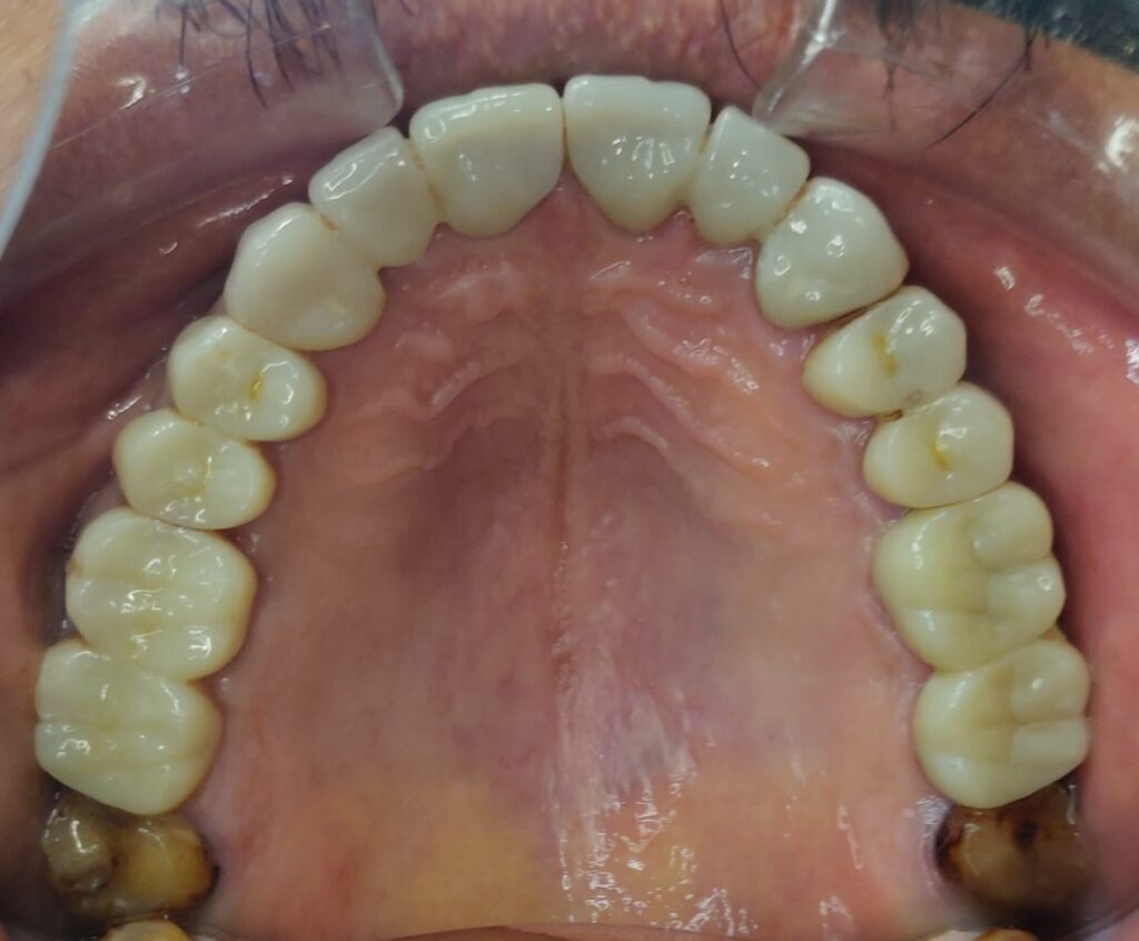 Full Mouth Rehabilitation with Dental Crowns