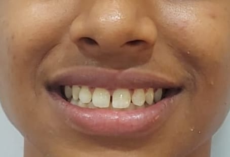 dental crown case study