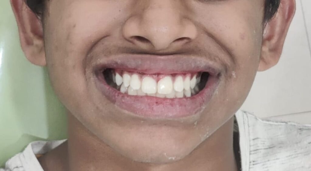 dental crown case study