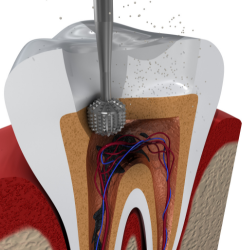 Root Canal Treatment