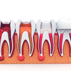 Root Canal Treatment